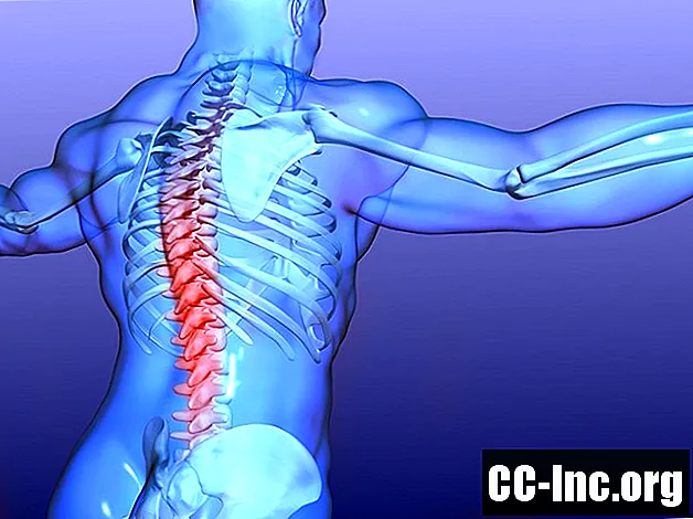 強直性脊椎炎と脊椎の痛み
