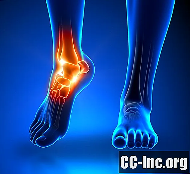 Er det nervesmerter som forårsaker smerter i foten? - Medisin