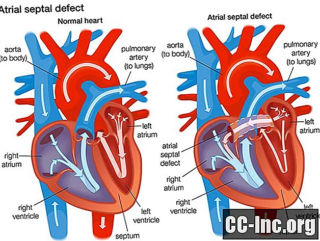 心房中隔欠損症（ASD）の説明