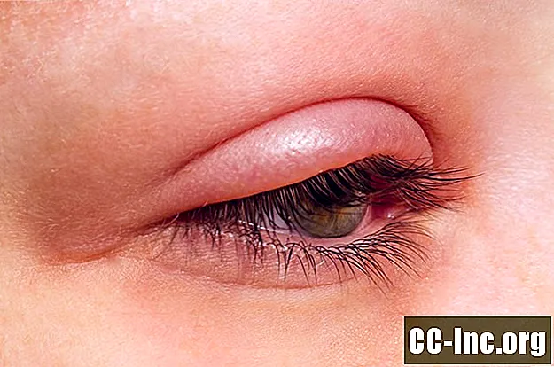 Blefarittyper - ögonlock och ögonfransar
