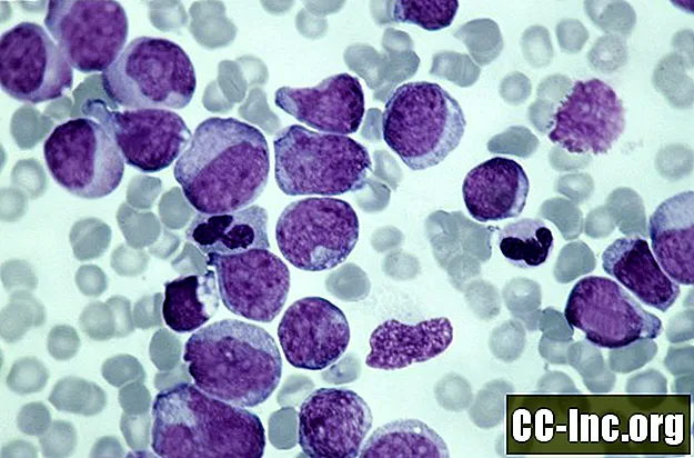 Câncer de sangue sob o microscópio