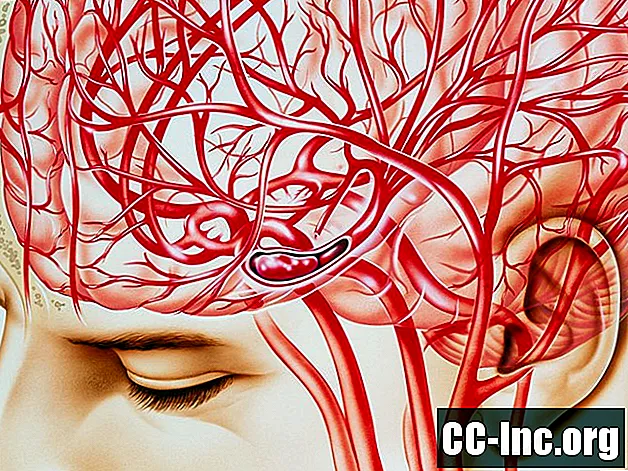 Krvne žile na koje moždani udar može utjecati