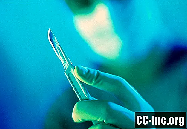 ¿Puede la circuncisión reducir el riesgo de que un hombre contraiga el VIH?