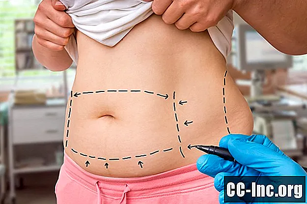 Ali lahko liposukcija povzroči povečanje telesne mase?