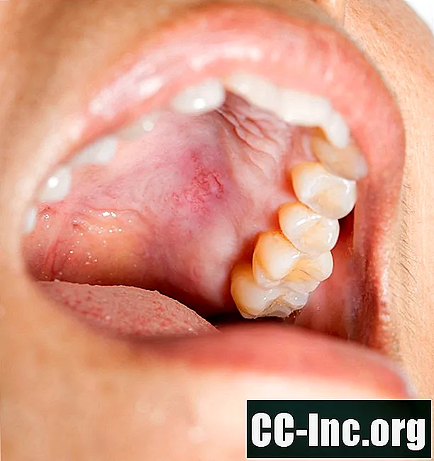 Caphosol للوقاية والعلاج من تقرحات الفم