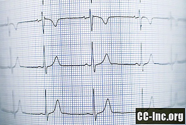 Καρδιακός κίνδυνος με αζιθρομυκίνη (Zithromax Z-Pack)