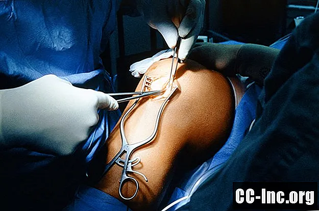 Utilizarea propriului țesut față de grefa donatorului pentru chirurgia ACL