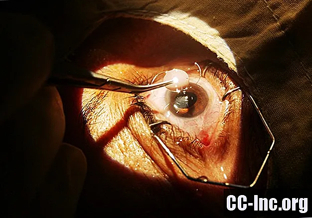 Cataractchirurgie: overzicht