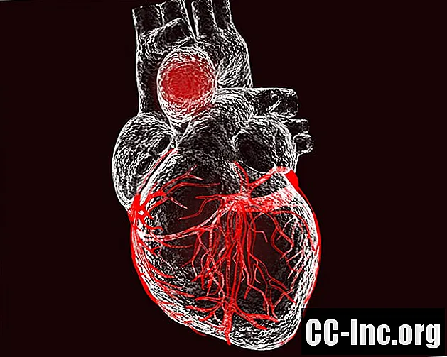 Mikä on aortan aneurysma?