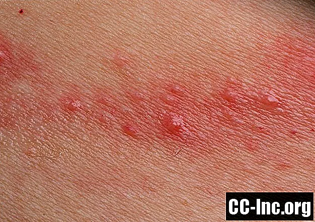 Causas e fatores de risco da dermatite de contato
