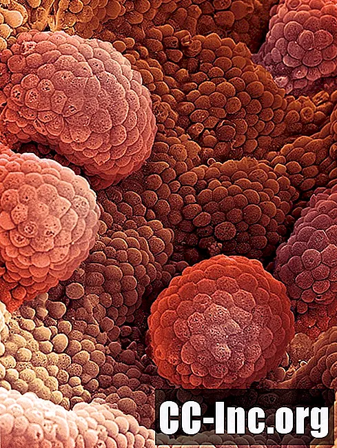 Nguyên nhân và các yếu tố nguy cơ của ung thư nội mạc tử cung - ThuốC