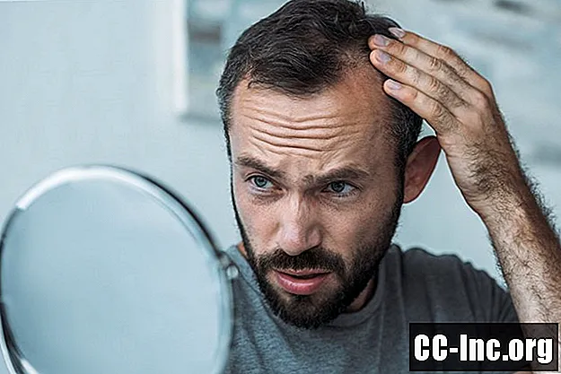 A frontális rostos alopecia (FFA) okai és kezelése