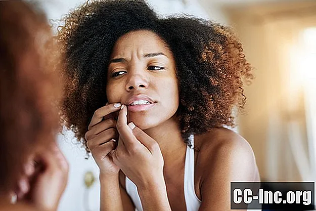 Oorzaken van acne littekens en hoe ze te voorkomen