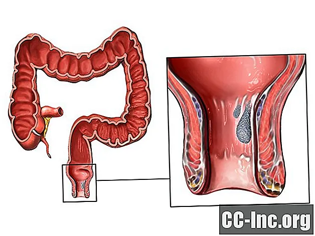Oorzaken van bloeding uit het rectum