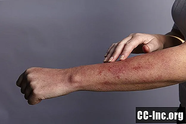Целиакия, чувствительность к глютену связана с кожными заболеваниями