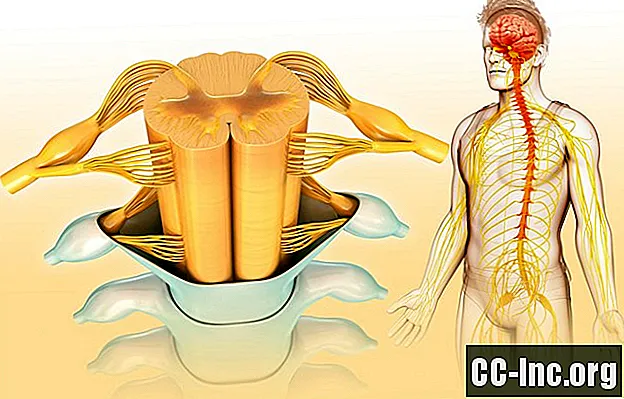 섬유 근육통 및 CFS의 중앙 감작