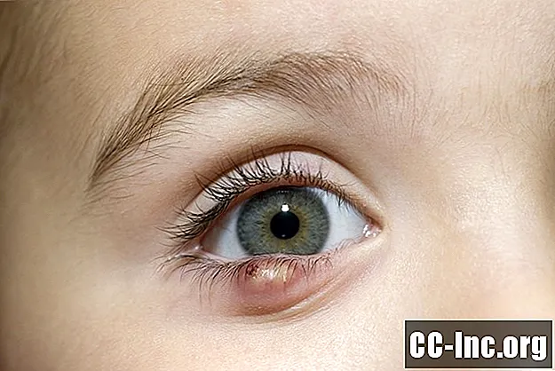 Simptome și tratamente ale Chalazion Eyelid Bump