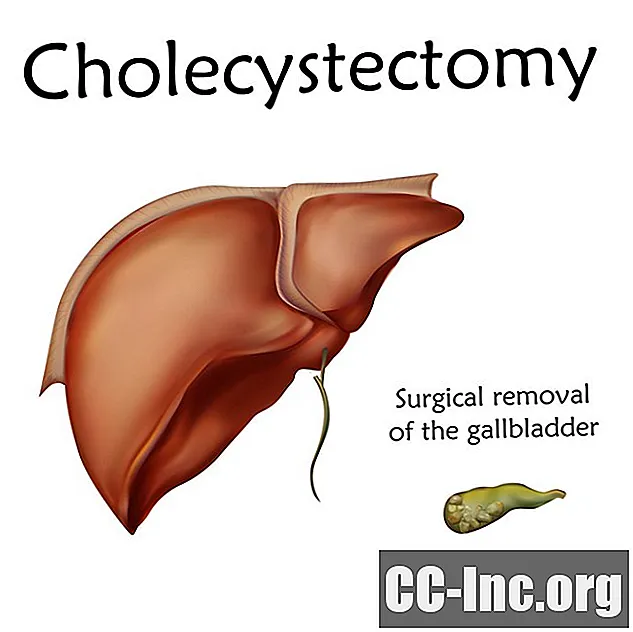 Cholecystectomie-operatie: alles wat u moet weten