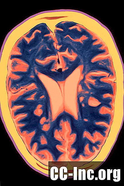 Insuffisance veineuse cérébrospinale chronique (IVCC) dans la sclérose en plaques