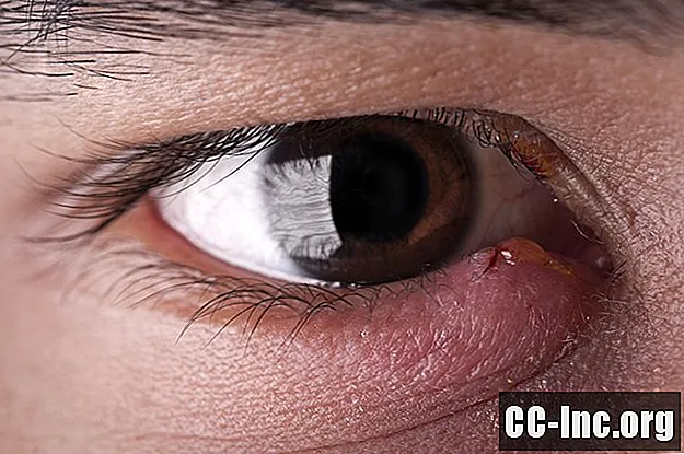Vanlige årsaker til hevelse i øyelokket