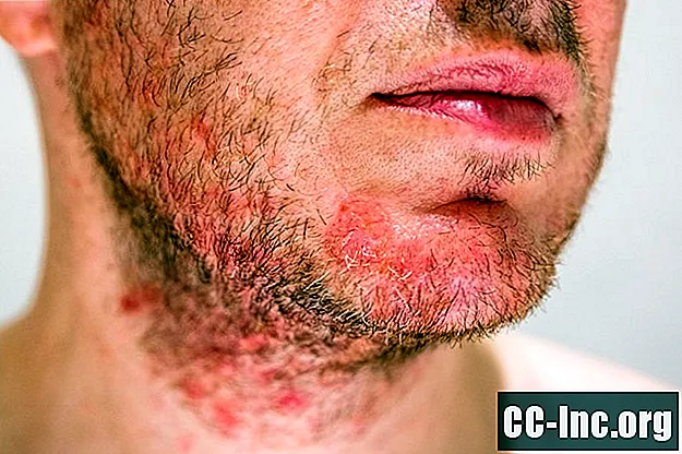 Các biến chứng của viêm nang lông ở HIV - ThuốC