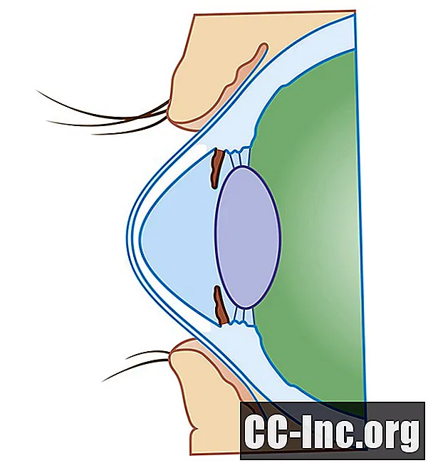 Visão geral da ligação cruzada da córnea