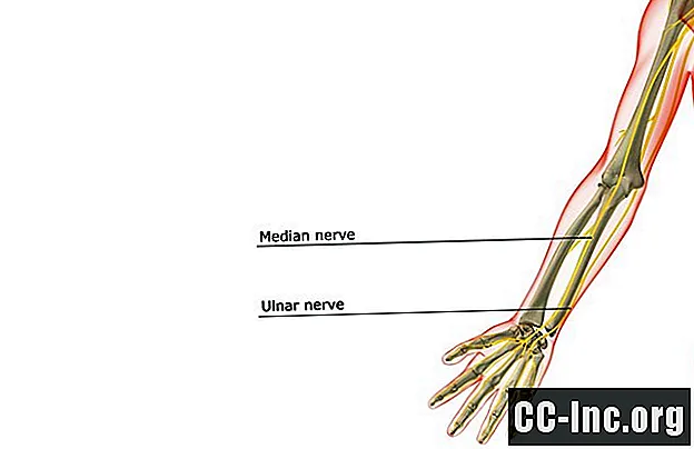 Các triệu chứng và điều trị hội chứng đường hầm Cubital - ThuốC