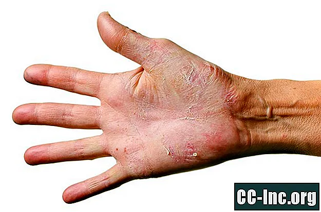 Dermatitis Herpetiformis mit Hautbiopsie diagnostiziert