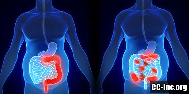 Erot haavaisen paksusuolitulehduksen ja Crohnin taudin välillä