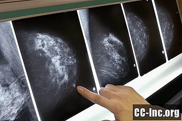 Distingerea tumorilor de cancer de sân de masele benigne