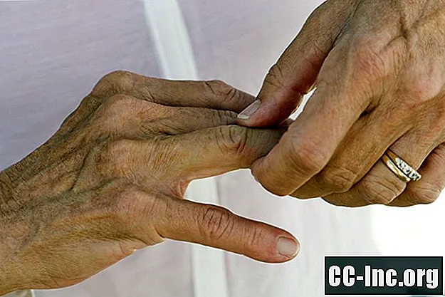 As rachaduras e rompimentos das articulações causam artrite?