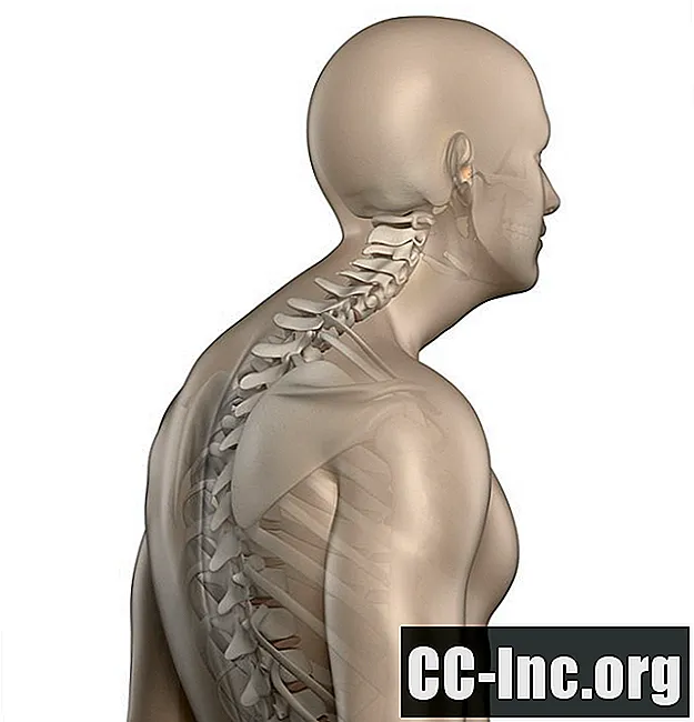 Cifosis dorsal y postura de espalda