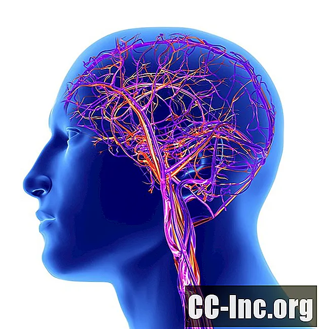 Duralna sinusna tromboza in možganska kap