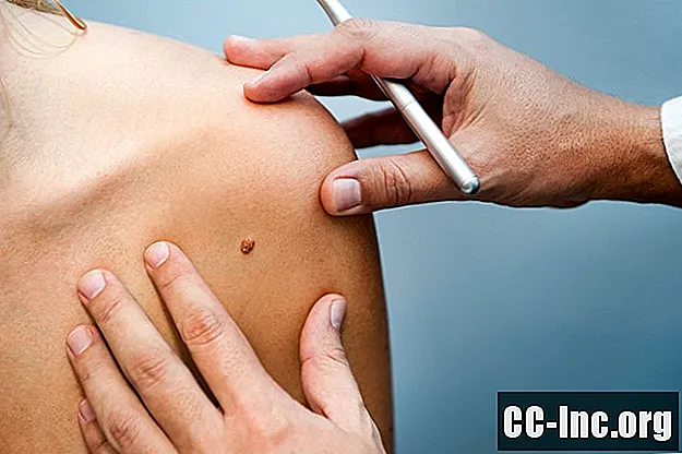 Mogućnosti liječenja melanoma u ranoj fazi