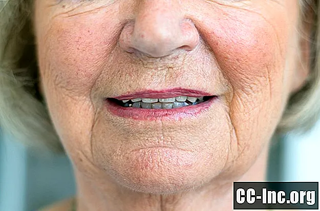 Facial Flushing en carcinoïde syndroom
