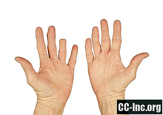 Ponowne założenie amputacji palca lub kciuka