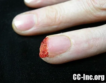Poškodba konice prsta - bo konica prsta zrasla nazaj?