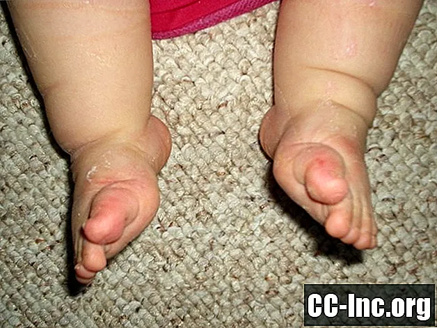 בעיות ועיוותים ברגליים אצל תינוקות שזה עתה נולדו