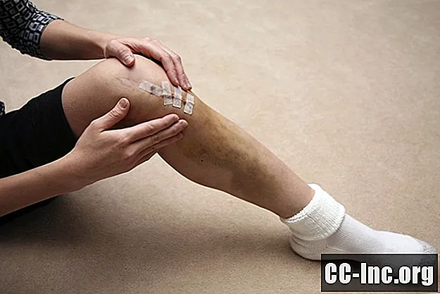 Gerafelde of gescheurde meniscus: wanneer een operatie nodig kan zijn
