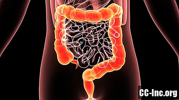 Fulminantni kolitis: kada debelo crijevo postane toksično