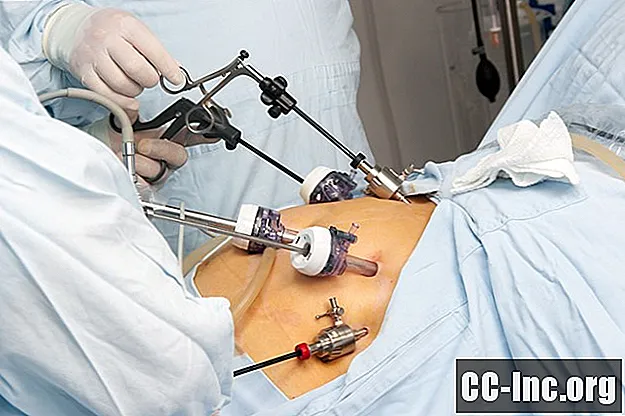 Magenbypass-Chirurgie: Übersicht