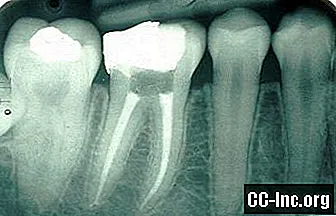 Установка зубной коронки на зуб