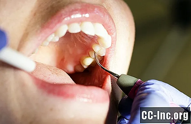 Sulkus dlesni in ohranjanje zdravih zob