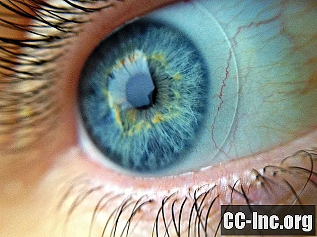 Infecciones de la córnea y el iris asociadas con el VIH