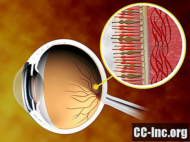 Okužbe mrežnice in optičnega živca, povezane z virusom HIV