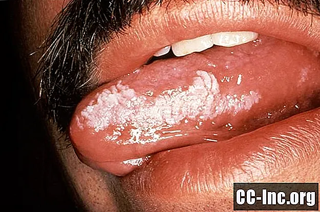 HIV và Bạch sản lông ở miệng - ThuốC