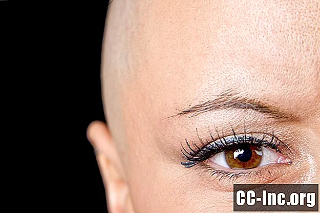 Hiusten uudelleenkasvu kemoterapian jälkeen