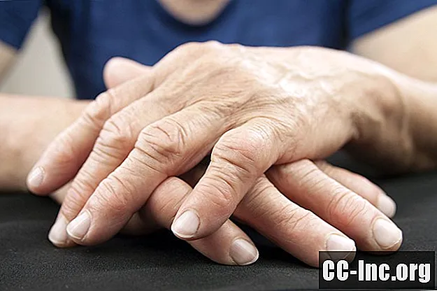 Handdeformität bei rheumatoider Arthritis