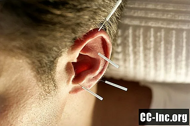 Beneficios para la salud de la acupuntura de oído