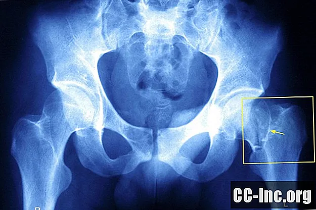 Types de fractures de la hanche et complications